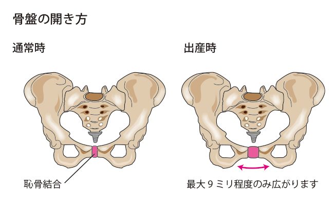 産後に骨盤が開いた状態を表す図