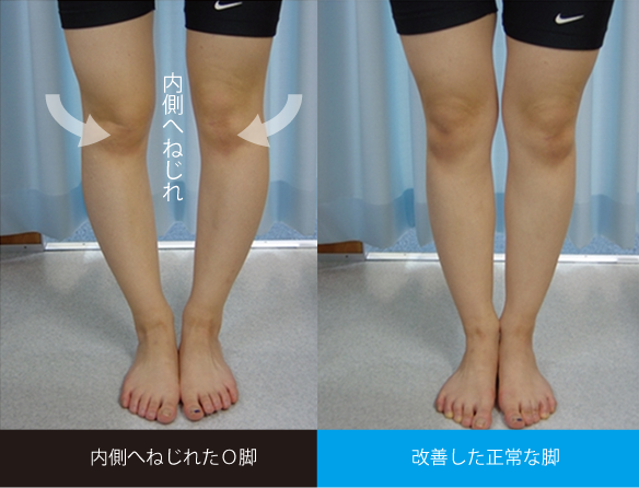 O脚は内側へのねじれいる状態で膝が離れる