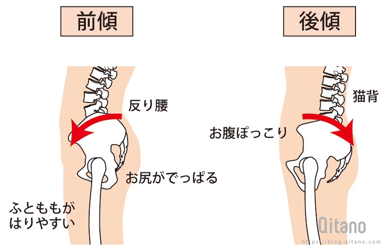 骨盤の前傾と後傾を改善して猫背を改善