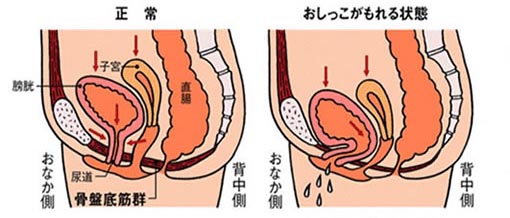 骨盤底筋が緩んだ尿もれのメカニズム