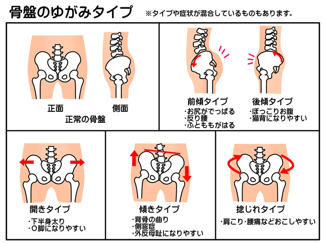 骨盤の歪みタイプ