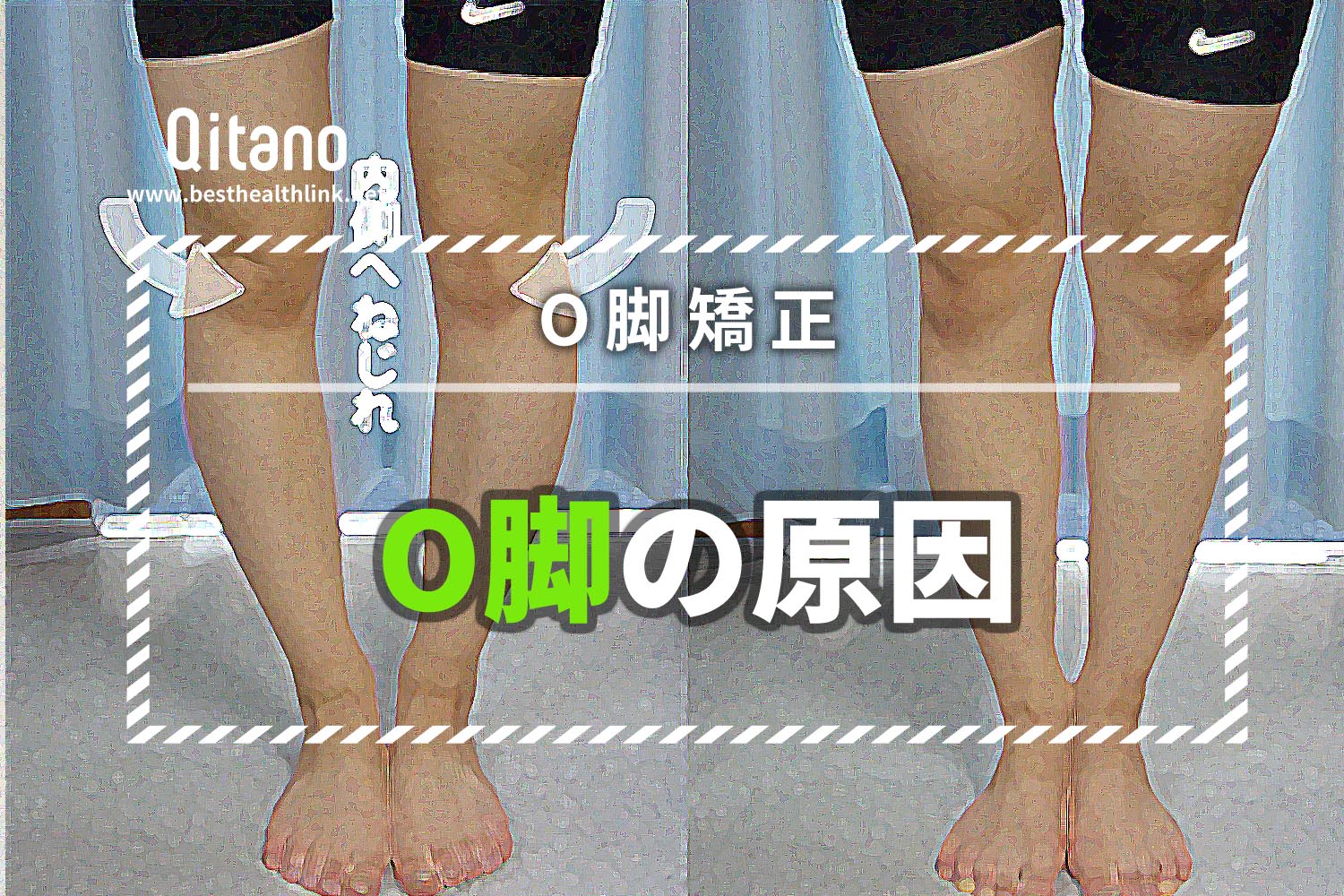 O脚の原因を知れば、改善も見えてくる!日本人に1番多い「内ねじれO脚」矯正法