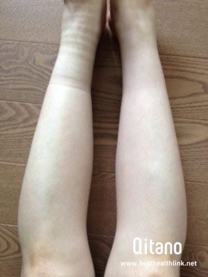 足のむくみ 靴下跡