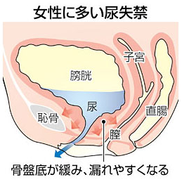 女性の尿漏れの原因は骨盤底筋のゆるみ