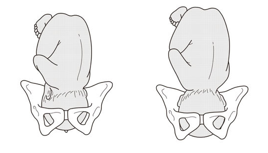 分娩による骨盤の開き、歪み方
