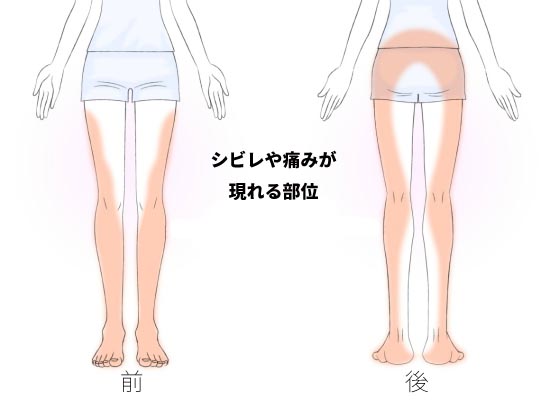 坐骨神経痛が現れる部位