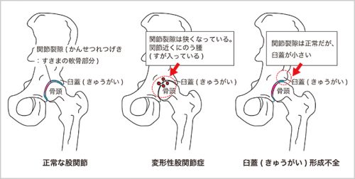 変形した股関節の原因