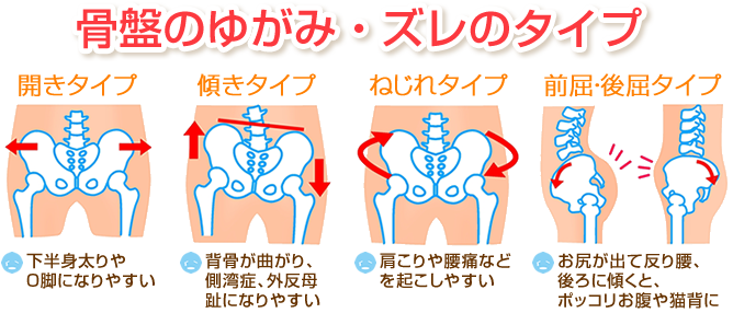 骨盤の歪み・ずれタイプ