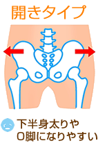 骨盤の歪みタイプ「左右に開く」