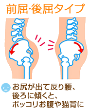 骨盤の歪みタイプ「前後に傾く」
