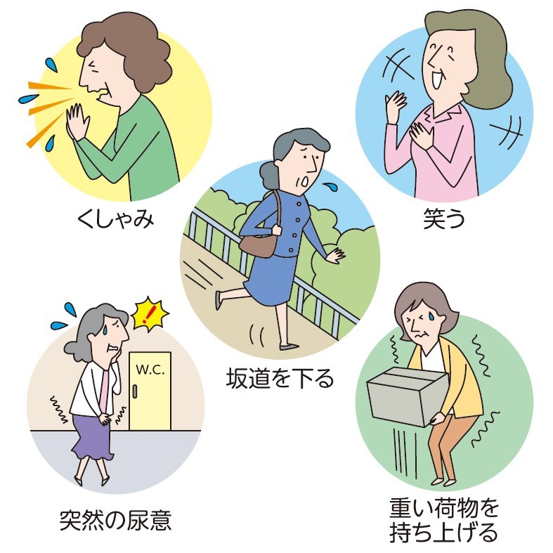 くしゃみ、笑う、坂道を下る、突然の尿意、重いものを持ちあげる時などで尿漏れ