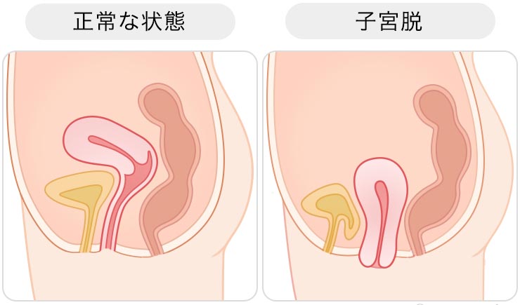子宮が下に下がる