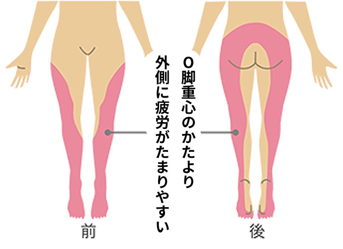 O脚の立ち姿勢歩き姿勢で偏る重心