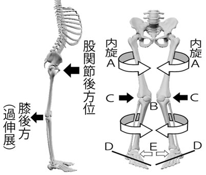内股のメカニズム